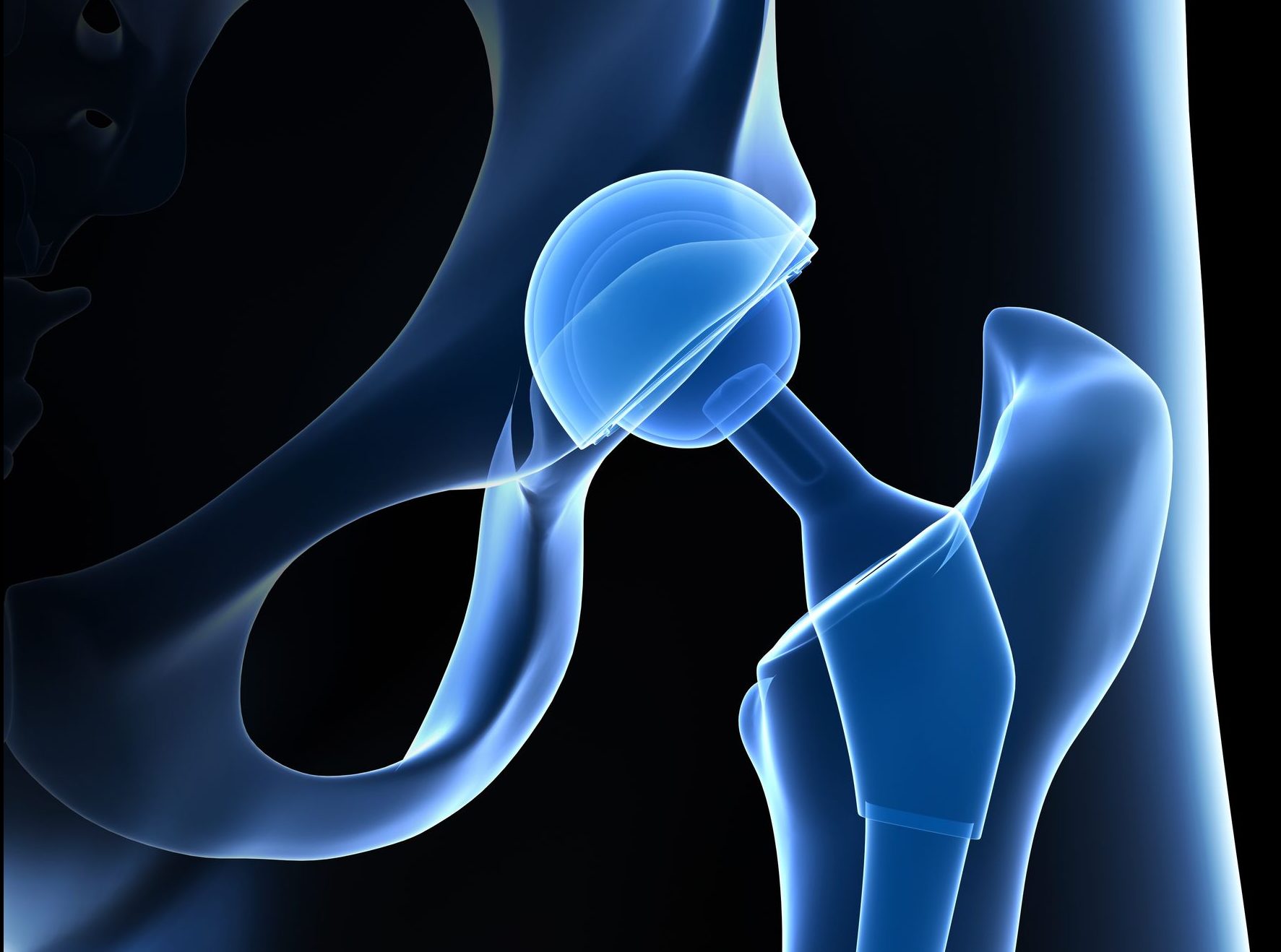 3D rendered illustration of a hip replacement